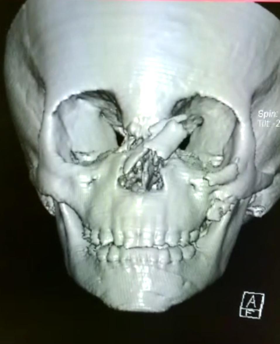 Dentista reconstrói rosto da criança indígena atacada por Pitbull